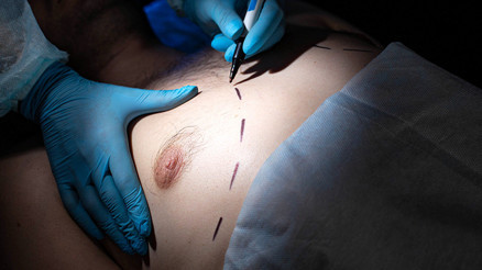 Erkeklerde Meme Küçültme (Jinekomasti) Nedir, Nasıl Yapılır Ve Ortalama Fiyatları Nelerdir