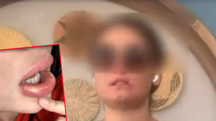 Dolgun dudak isteği kâbus oldu
