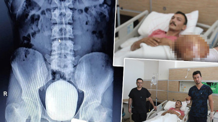 Yanma şikayetiyle gitti, mesanesinden 1 kilo taş çıktı