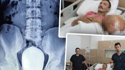 Hastaneye başvuran hastanın mesanesinden 1 kilo taş çıktı