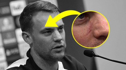 Manuel Neuer cilt kanseri olduğunu açıkladı 3 kez ameliyat oldum...