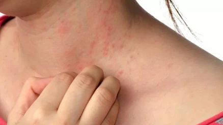 Scabies nedir Scabies hastalığı hakkında önemli uyarılar