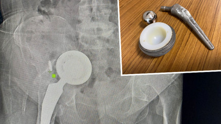 Ameliyat ol diyen doktorları dinlemedi Kalça protezi karnından çıktı Ameliyat ol diyen doktorları dinlemedi Kalça protezi karnından çıktı