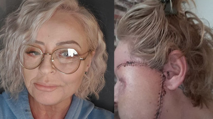 Et yiyen bakteri nedeni ile yüzünün yarısını kaybetti Yaşadığım korkunç olay sayesinde aşkı buldum