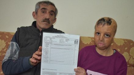 Suriye’de bomba düşen evlerinde yüzü yanan Evin, 10 yılda 109 ameliyat oldu Suriye’de bomba düşen evlerinde yüzü yanan Evin, 10 yılda 109 ameliyat oldu