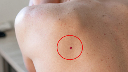 Cilt kanseri neden erkekler için daha ölümcül ‘Özellikle partneri olmayanlar risk altında’