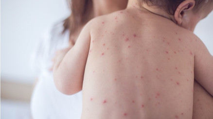 1 yaşında yapılması gereken kızamık aşısını 9uncu ayda yaptırırsak ne olur 1 yaşında yapılması gereken kızamık aşısını 9uncu ayda yaptırırsak ne olur