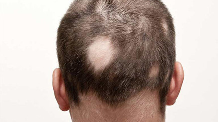 Alopesi Areata hastalığı nedir Saçkıran hastalığı neden olur, tedavisi var mı