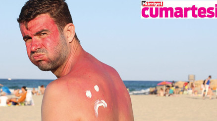 Güneş yanıklarına teslim olmayın