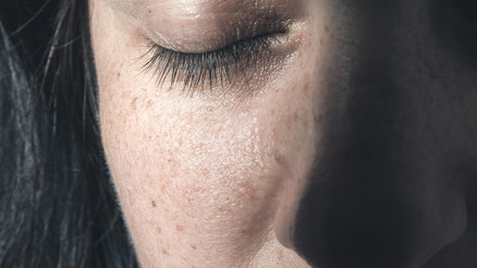 Doktorlar çilimi egzama zannetti, 4üncü evre kanser çıktı... Hangi lekeler tehlikeli Nasıl ayırt edeceğiz