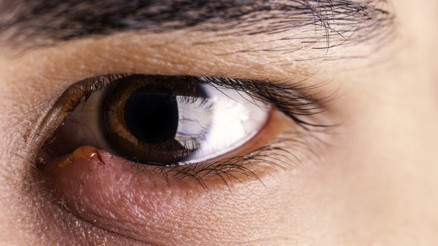 Kullandığı deneme ürününden bulaşan bakteri yüzünden geçici görme kaybı yaşadı... Göz selüliti ciddi vakalarda göz kaybına bile neden olabilir Kullandığı deneme ürününden bulaşan bakteri yüzünden geçici görme kaybı yaşadı... Göz selüliti ciddi vakalarda göz kaybına bile neden olabilir