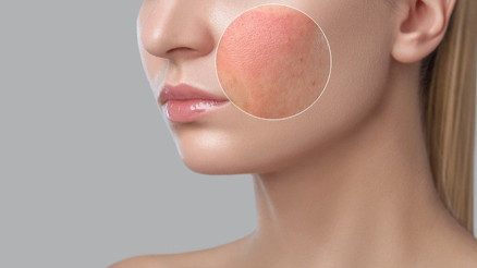 Seboreik dermatit sorunuyla nasıl baş edeceğiz Seboreik dermatit sorunuyla nasıl baş edeceğiz