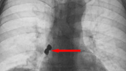 Afyonkarahisar’da diş doktorunda yanlışlıkla implantı yuttu