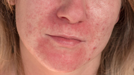 Doktorlar egzama sandı... Meğer aylarca çektiği acıların nedeni diş kaplamalarıymış Kollarımı indiremiyor, duş bile alamıyordum