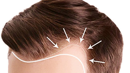 Saç dökülmesi kader olmaktan çıkıyor