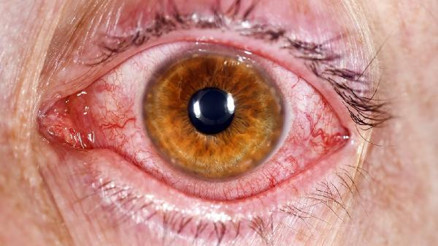 O ülkede kırmzı göz hastalığı okulları tatil ettirdi... Çocuklarda görüldü: gözlerde kızarıklık, yanma, kaşıntı ve akıntı...