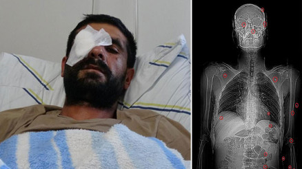 Korkunç olay Hasımları av tüfeğiyle vurdu: Bir gözünü kaybetti, vücudunda 32 saçmayla yaşıyor