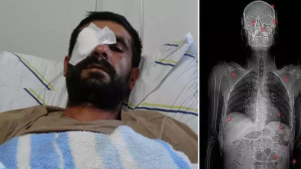 Hasımları av tüfeğiyle vurdu: Bir gözünü kaybetti, vücudunda 32 saçmayla yaşıyor