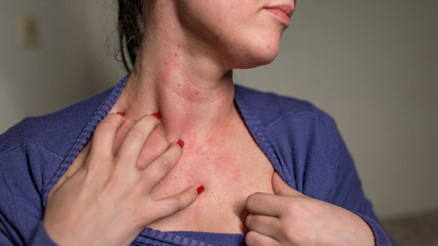 ‘Bugün gelen 8inci vakasın’ Hem dünyada hem Türkiye’de uyuz vakaları ciddi oranda arttı… Bu hastalıktan nasıl korunmalıyız | 6 SORU 6 YANIT ‘Bugün gelen 8inci vakasın’ Hem dünyada hem Türkiye’de uyuz vakaları ciddi oranda arttı… Bu hastalıktan nasıl korunmalıyız | 6 SORU 6 YANIT