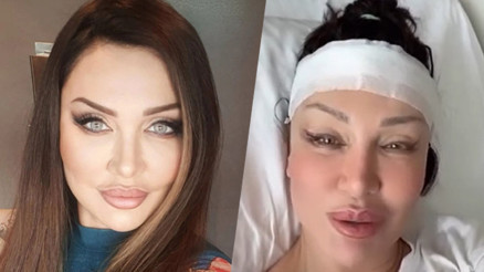 Umut Akyürek bıçak altına yattı: Alın daraltma ameliyatı geçirdim Umut Akyürek bıçak altına yattı: Alın daraltma ameliyatı geçirdim