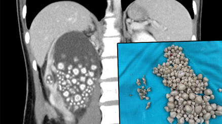 Sosyal medya bu görüntüyü konuşuyor... Böbreklerinden 300 taş çıkarıldı