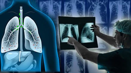 Çin ve ABD’den sonra Avrupada da görüldü: Beyaz akciğer sendromu… İnsandan insana bulaşıyor, antibiyotik tedavisi sonuç vermiyor Çin ve ABD’den sonra Avrupada da görüldü: Beyaz akciğer sendromu… İnsandan insana bulaşıyor, antibiyotik tedavisi sonuç vermiyor