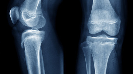 Çocukluk çağında diz kapağı çıkıklarında yaklaşım nasıldır