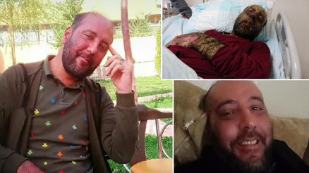 Koronavirüse yakalandıktan sonra milyonda 2 görülen pemfigus hastalığına yakalandı Yüzü 1 senede bu hale geldi