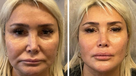 60 yaşındaki Yonca Evcimik estetik yaptırdı 30 yaş gençleşmiş
