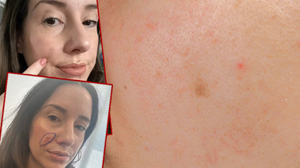 Yüzündeki lekeleri normal sanıyordu, aldığı teşhisle çok büyük bir şok yaşadı Hayatını kurtaran bir televizyon programı oldu