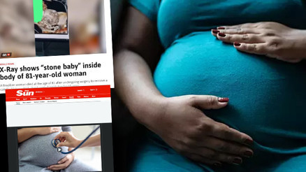 56 yıl karnında taşıdığı taş bebek yüzünden hayatını kaybetti Doktorlar karın ağrısının nedeninin kanser olduğunu düşünüyordu...