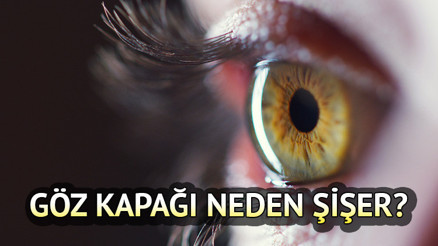 Göz kapağı neden şişer, nasıl geçer Göz kapağı şişmesine ne iyi gelir