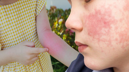 ‘Beşinci hastalık’ vakaları artmaya başladı 5-15 yaş arası çocukları hedef alıyor…Çeşitli bulaşıcı hastalıklarla karıştırılıyor