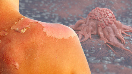 22 yaşında dördüncü evre cilt kanseri teşhisi kondu… Hiçbir belirti vermeden ilerlemiş, lenf düğümlerine yayılmış