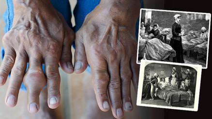 Viktorya dönemi hastalığı dirildi Vaka sayısı 41 milyona ulaştı… ‘Hızla artış gösteriyor, bir ‘salgın’ gibi davrandığından söz edebiliriz’