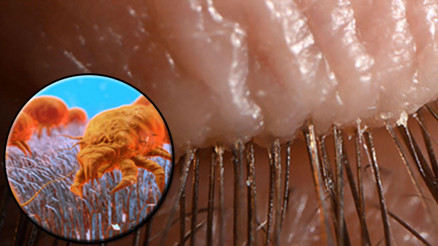 Kirpiklerimizde yaşayan binlerce böcek var Nereden geliyor Endişelenmeli miyiz