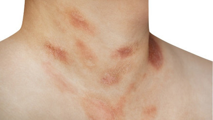 Gül Hastalığı (Rosacea) ile nasıl başa çıkılır