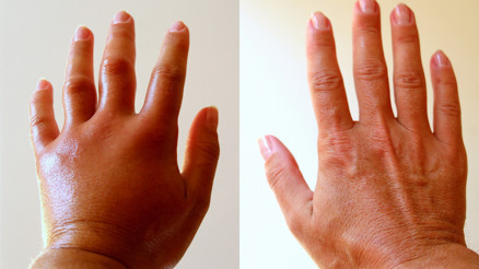 Vücudu o kadar şişiyor ki kalp krizi geçiriyormuş gibi hissediyor... Aşırı şişme hastalığı ile tanışın