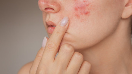 Sıcak havalarda artabiliyor... Yaz mevsiminde sivilcelerin tekrarlamaması için 10 öneri