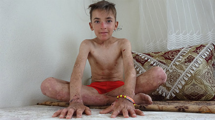 Deri hastalığı hayatını kâbusa çevirdi Vücudu sürekli kanıyor Deri hastalığı hayatını kâbusa çevirdi Vücudu sürekli kanıyor