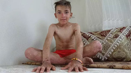 Deri hastalığı hayatını kâbusa çevirdi Arkadaşlarının dalga geçtiği deri hastalığından kurtulmak istiyor Deri hastalığı hayatını kâbusa çevirdi Arkadaşlarının dalga geçtiği deri hastalığından kurtulmak istiyor