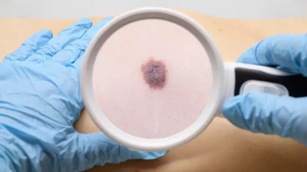 Henüz 22 yaşında dördüncü evre cilt kanseri ile mücadele ediyor... Üstelik en ufacık bir belirtisi dahi yoktu