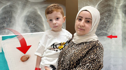 Anne babalar dikkat 3 yıl boyunca şikayeti geçmeyen çocuğun nefes borusundan çıktı, doktorlar şaşkına döndü