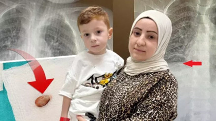 Doktorları bile şaşırtan vaka: Nefes borusundaki çekirdekle 3 yıl yaşadı