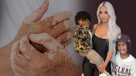 Vaka sayısı giderek artıyor Kardashian’ın oğlu da yakalandı… ‘İlk kez duydum, sedefe benziyor’ | ‘Ülkemizde görülme sıklığı yüzde 11,5’
