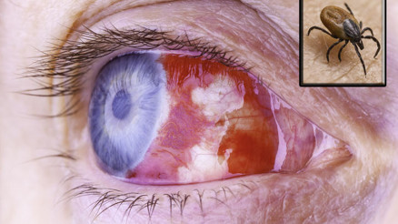 Bu virüsün aşısı yok Kene ısırığı sonucu hayatını kaybetti. Burun ve gözlerde ölümcül kanamaya neden oluyor Bu virüsün aşısı yok Kene ısırığı sonucu hayatını kaybetti. Burun ve gözlerde ölümcül kanamaya neden oluyor