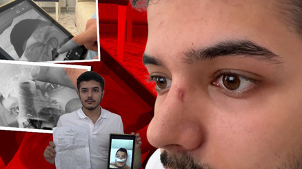 Estetik ameliyatı sonrası hayatı kâbusa döndü Burnunda delik oluştu... Doktordan aldığı cevapla ikinci şoku yaşadı