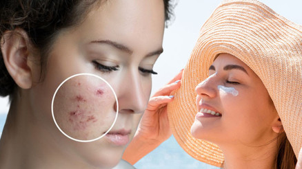 Sosyal medyadaki yeni trend şaşırttı: Sivilcesi olanlar çareyi güneş yanığında buldu ‘Böyle bir etkiden söz edilebilir ama…’