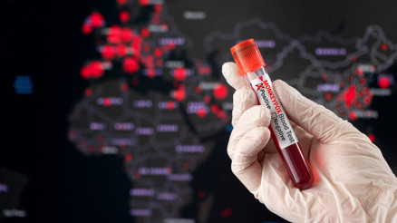 Maymun çiçeği Türkiyede görüldü mü 28 Ağustos son durum || Maymun çiçeği hastalığı ölümcül mü Maymun çiçeği Türkiyede görüldü mü 28 Ağustos son durum || Maymun çiçeği hastalığı ölümcül mü