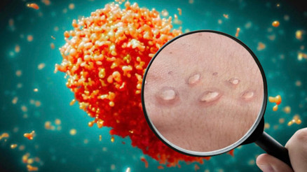 Maymun çiçeği (mpox) virüsü belirtileri nelerdir, nasıl bulaşır Maymun çiçeği Türkiyede var mı, ölümcül mü, tedavisi nedir İşte DSÖnün acil durum ilan ettiği maymun çiçeği hakkında bilgiler